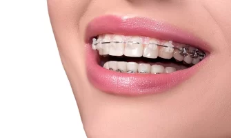 Diş Teli Nasıl Takılır?