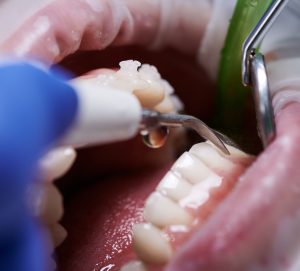 How to Remove Tartar?